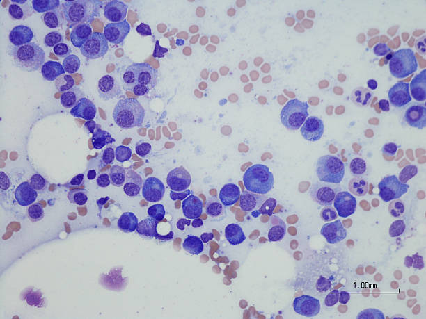 Plasma cell myeloma from bone marrow aspirate. Microscopic photo of a professionally prepared slide demonstrating Plasma cell myeloma from bone marrow aspirate. Wright Giemsa stain. magnification stock pictures, royalty-free photos & images