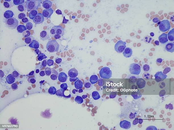 Plasma Cell Myeloma From Bone Marrow Aspirate Stock Photo - Download Image Now - Myeloma, Cancer Cell, Biological Cell