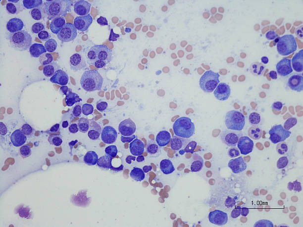 osocze komórka ds. szpiczaka mnogiego z regeneracją szpiku kostnego. - microscope slide zdjęcia i obrazy z banku zdjęć