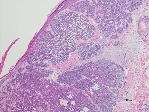 carcinoma de células basales. h & e tinción. - human tissue histology dermatology human skin fotografías e imágenes de stock