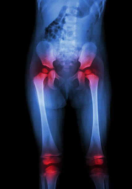 arthritis an beiden seiten der hüfte, beide knie (gout, chronischen) - haunch stock-fotos und bilder