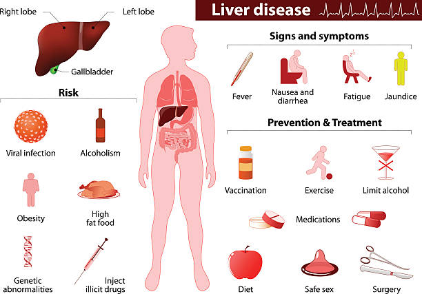 choroba wątroby. medical grafika informacyjna - cirrhosis stock illustrations