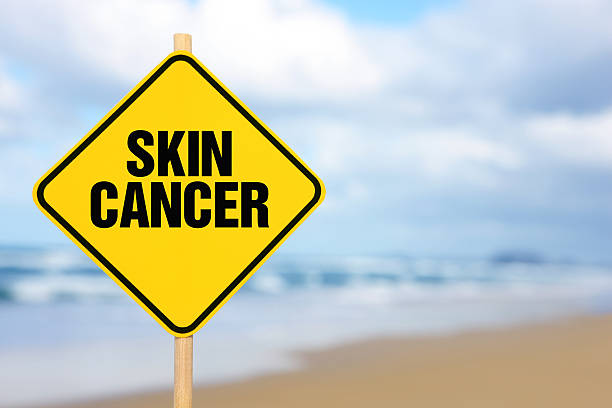 istock Skin Cancer 497795865