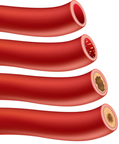 죽상동맥경화증 - blood cell anemia cell structure red blood cell stock illustrations