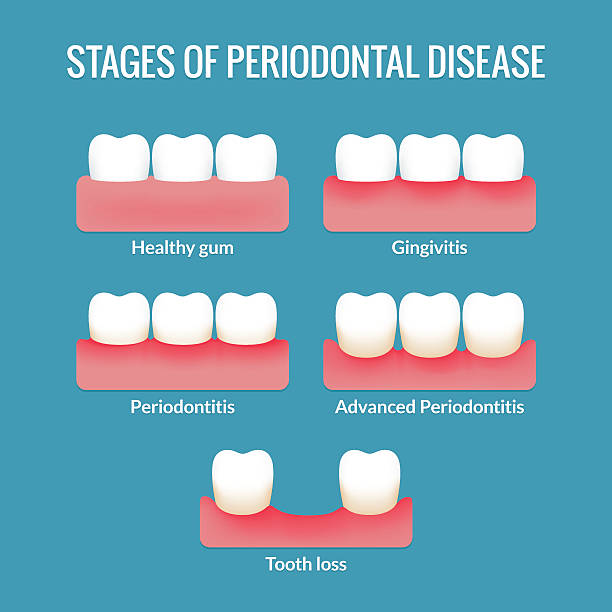 zapalenie przyzębia tabela - human teeth gums dental hygiene inflammation stock illustrations