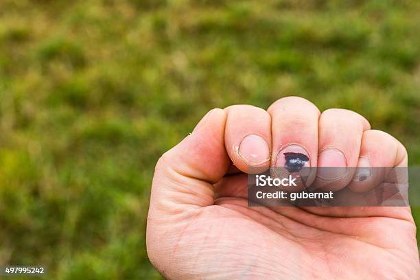 Subunguale Hämatom Stockfoto und mehr Bilder von 2015 - 2015, Beschädigt, Blauer Fleck