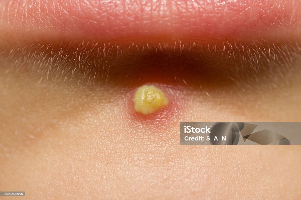 Acne Pimple on a girls chin Acne Stock Photo