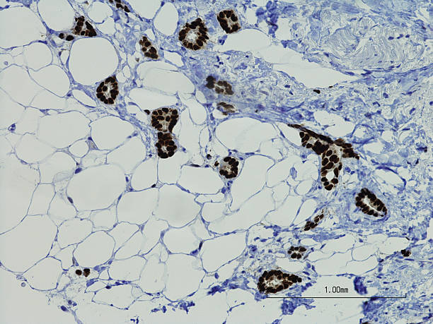 istock Low grade ductal carcinoma with positive estrogen receptor 498141328