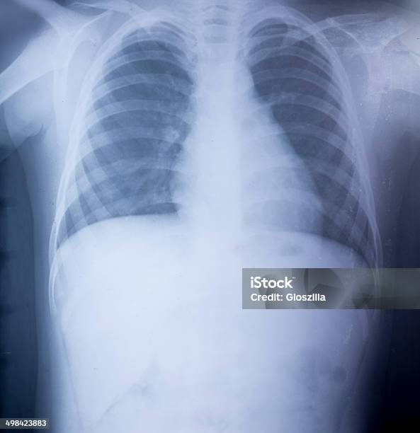 Xray Image Of Human Chest For A Medical Diagnosis Stock Photo - Download Image Now - Anatomy, Doctor, Education