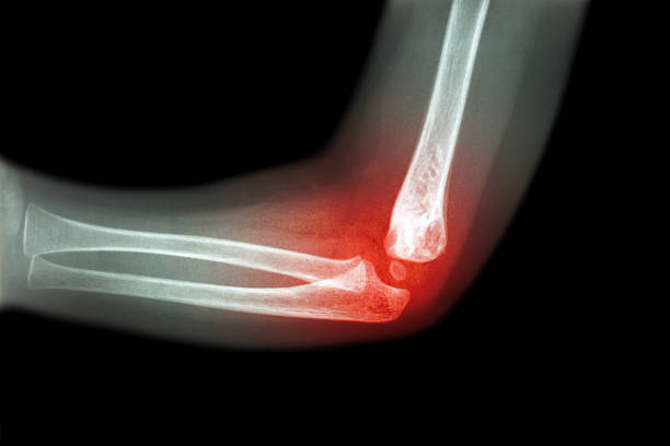 Rheumatoid arthritis , Gouty arthritis ( film x-ray child 's elbow with arthritis at elbow ) ( Side view , Lateral )