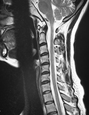 human cervical vertebra T2 weighted image of magnetic   resonance image(MRI)  isolated on black background