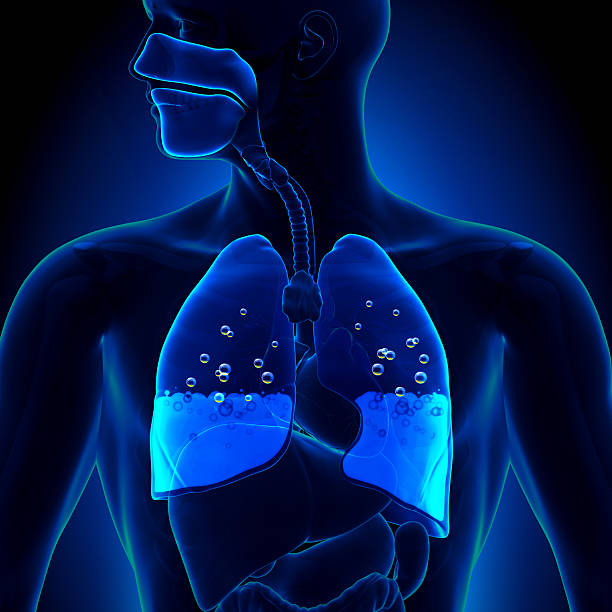 Pulmonary Edema - Water in Lungs Pulmonary Edema - Water in Lungs decade stock pictures, royalty-free photos & images