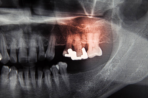 istock Panoramic dental X-Ray film for dentist 498567545