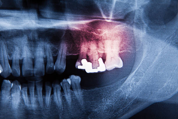 istock Panoramic dental X-Ray film for dentist 498569525