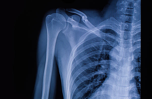 istock X-ray image of left clavicle fracture 498652156