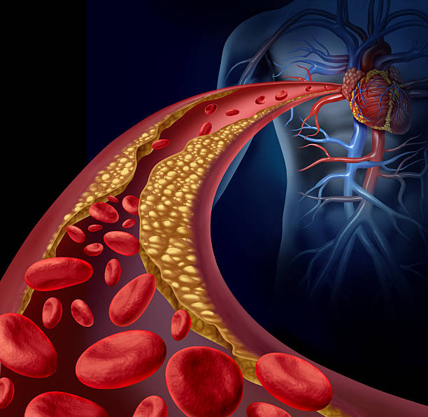 Clogged Artery Clogged artery and atherosclerosis disease medical concept with a three dimensional human artery with blood cells that is blocked by plaque buildup of cholesterol as a symbol of arteriosclerotic vascular diseases. occlusion stock pictures, royalty-free photos & images