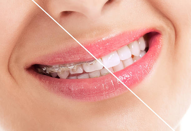 Beautiful heathy smile before and after braces Beautiful heathy smile before and after braces close up heathy stock pictures, royalty-free photos & images