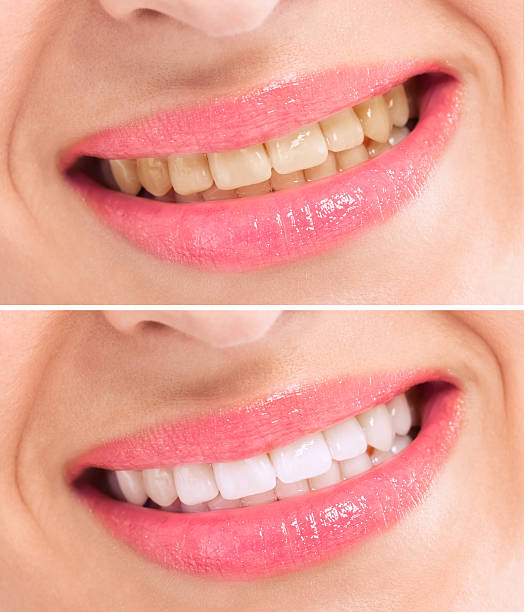 istock Before and after whitening treatment teeth 498836914