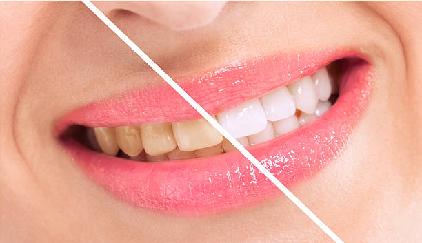 violano teatment, perfetto whiten denti donna - human teeth whitening dentist smiling foto e immagini stock