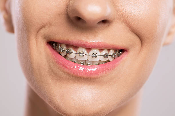 sonrisa saludable con aparatos de ortodoncia - banda correctora fotografías e imágenes de stock