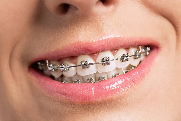 istock Happy success smile with perfect teeth and braces 498837110