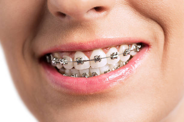 istock Prety girl smiling with braces 498837994