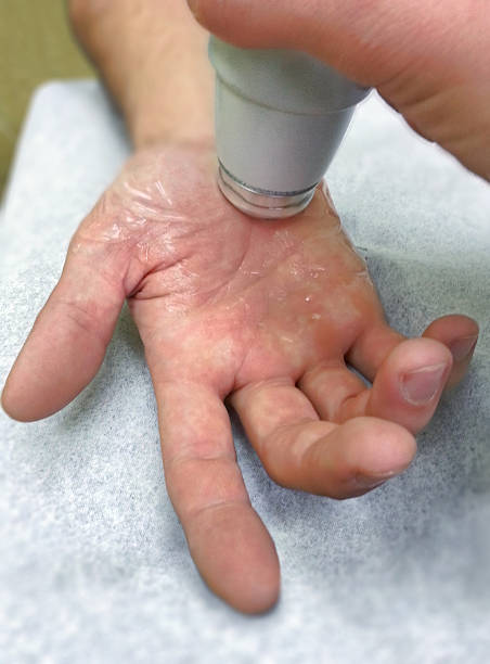 istock Ultrasound therapy treatment 498918646