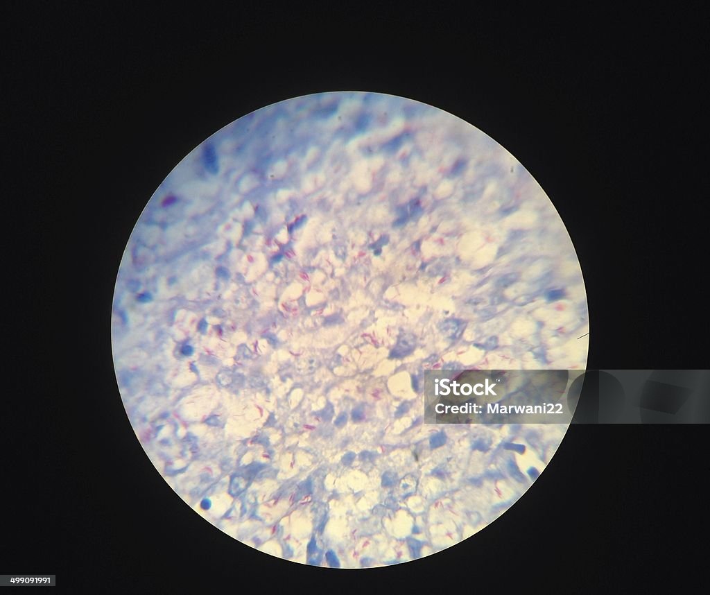 Tinción acidorresistente - Foto de stock de Bacteria de la tuberculosis libre de derechos