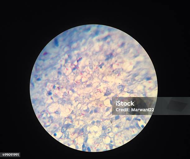 Tinción Acidorresistente Foto de stock y más banco de imágenes de Bacteria de la tuberculosis - Bacteria de la tuberculosis, Bacteria, Enfermedad