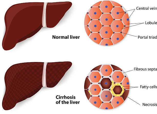 gesunde leber und zirrhose - alimentary stock-grafiken, -clipart, -cartoons und -symbole