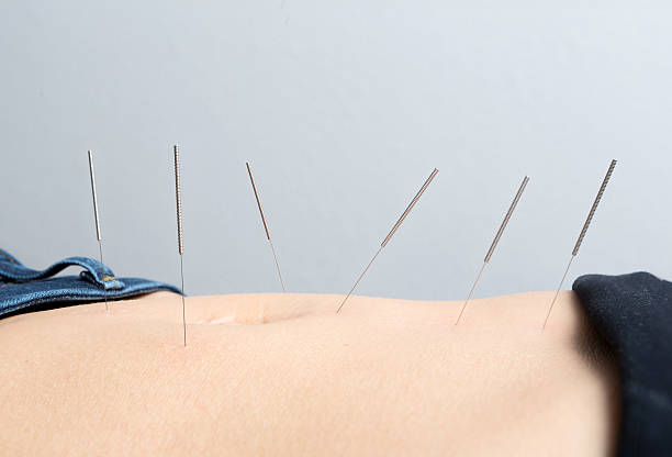 Acupuncture needles in skin stock photo