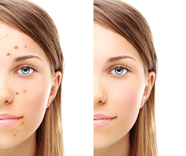 istock Girl with problem and clear skin. 499125002