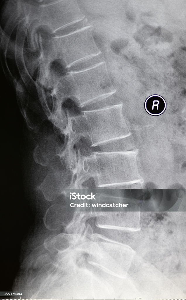 human lumbar vertebra x-ray image human lumbar vertebra x-ray image(lateral position) X-ray Image Stock Photo