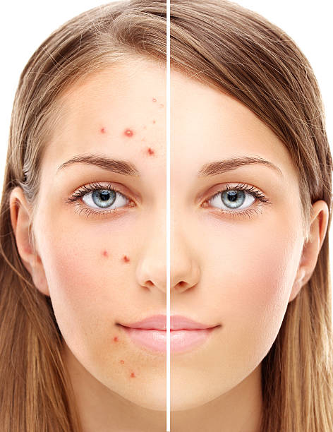 istock Girl with problem and clear skin. 499206902