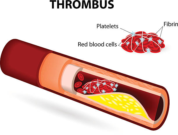 skrzeplina - human artery cholesterol atherosclerosis human heart stock illustrations