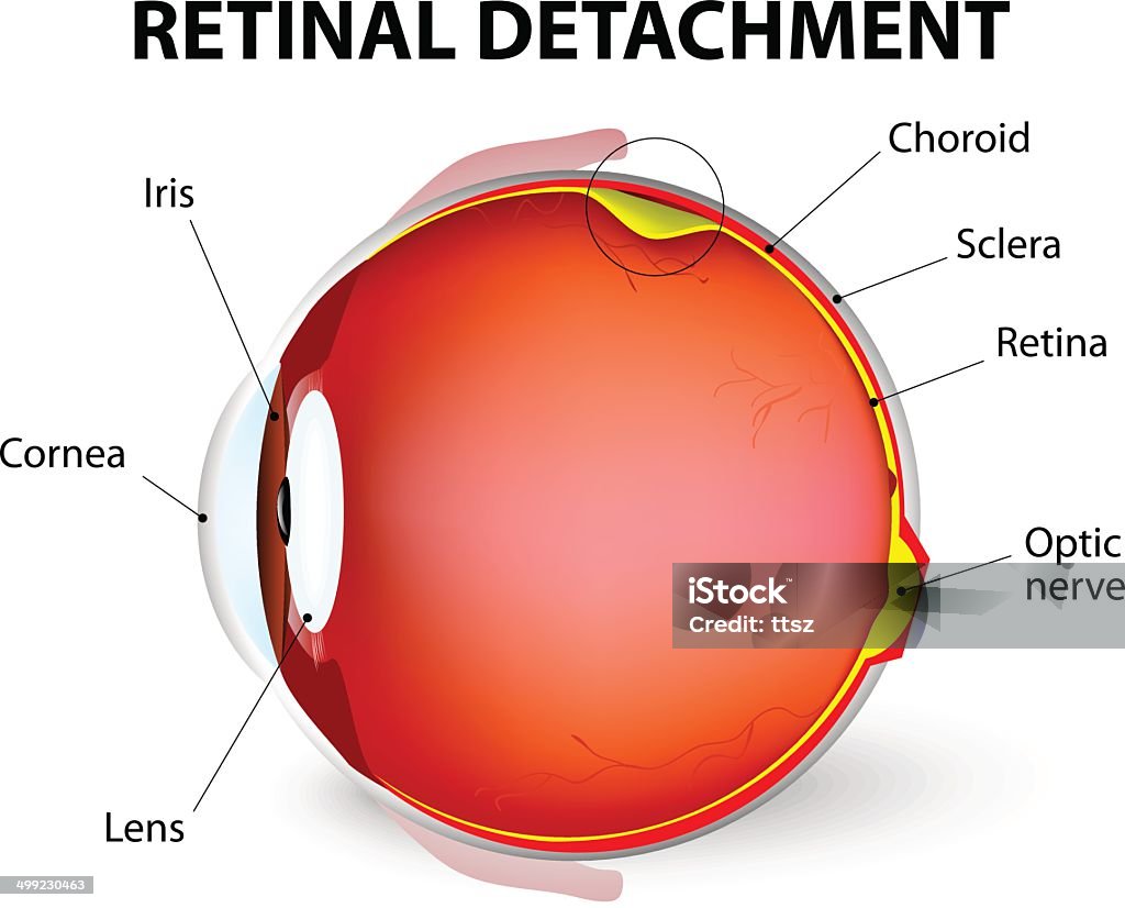 Retinal detachment. Vector diagram Retinal detachment is an eye disease in which the part containing the optic nerve is removed from its usual position at the back of the eye. The retina is the light-sensitive layer of tissue that lines the inside of the eye and sends visual messages through the optic nerve to the brain. Retina stock vector