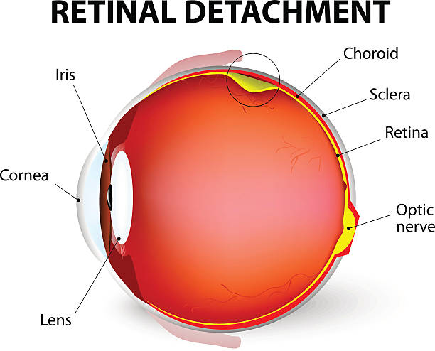 Retinal detachment. Vector diagram Retinal detachment is an eye disease in which the part containing the optic nerve is removed from its usual position at the back of the eye. The retina is the light-sensitive layer of tissue that lines the inside of the eye and sends visual messages through the optic nerve to the brain. animal retina illustrations stock illustrations