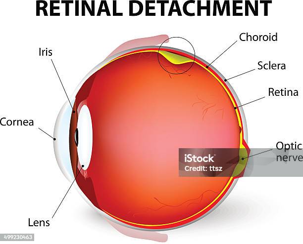 Retinal Detachment Vector Diagram Stock Illustration - Download Image Now - Retina, Detached House, Eye