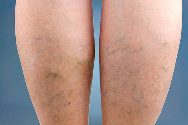 Varicose veins Varicose veins. Macro. spider veins stock pictures, royalty-free photos & images