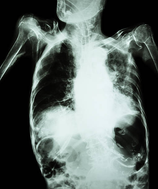 istock Pulmonary Tuberculosis with acute respiratory failure 499377732