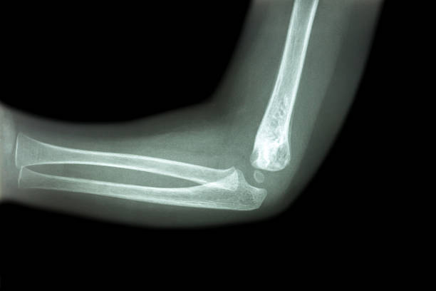 istock Film x-ray of child 's elbow 499377764