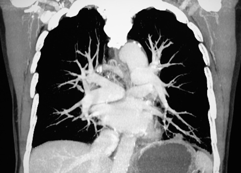 pulmonary artery computed tomography image