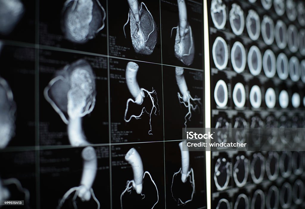 human heart and coronary artery  images human heart and coronary artery  CT images on black film. Heart Disease Stock Photo