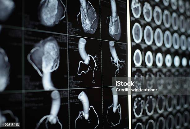 Human Heart And Coronary Artery Images Stock Photo - Download Image Now - Heart Disease, CAT Scan, Medical Scan