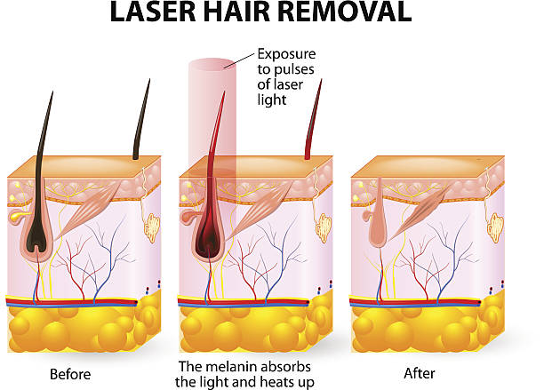 ilustraciones, imágenes clip art, dibujos animados e iconos de stock de láser depilación.  vector diagrama de - laser waxing human skin beauty