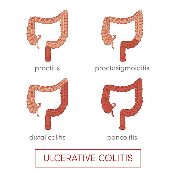 ulcerative colitis ベクター - descending colon点のイラスト素材／クリップアート素材／マンガ素材／アイコン素材