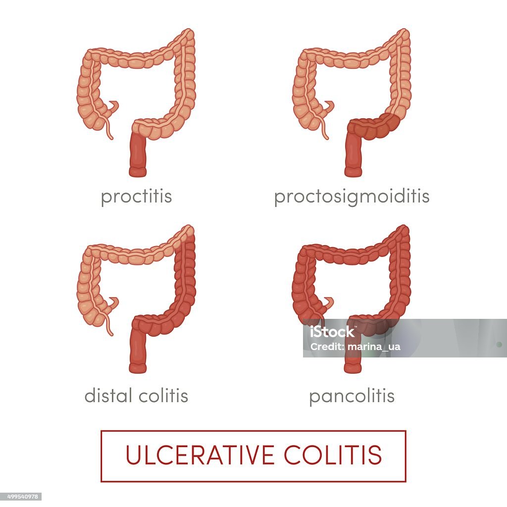 Ulcerative colitis vector Types of ulcerative colitis. Cartoon vector illustration for medical atlas or educational textbook. 2015 stock vector
