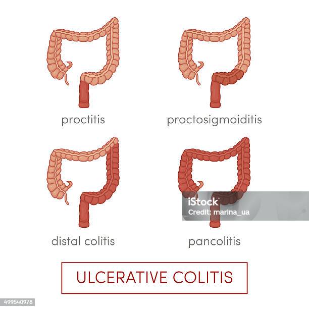 Ulcerative Colitis Vector Stock Illustration - Download Image Now - 2015, Amebiasis, Amoebic Colitis