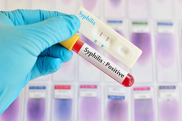 Syphilis testing positive stock photo