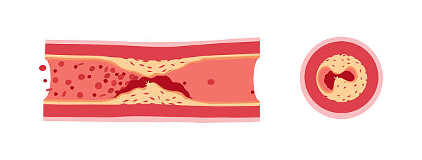 atherotrombosis w naczyniach - healthcare and medicine human cardiovascular system anatomy human blood vessel stock illustrations